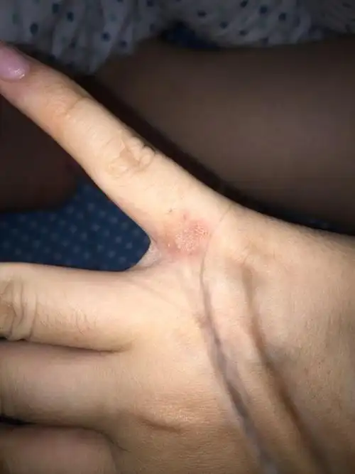 湿疹还是手癣咨询