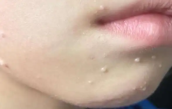 皮脂腺瘤图片(皮肤上长了小肉球) - 赤虎壹号