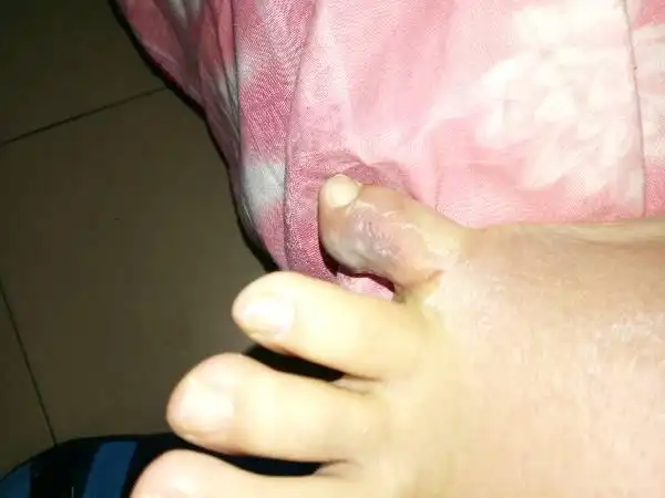 右脚小脚趾之间有水泡,肿痛情况,麻烦专家帮忙看看是什么毛病,谢谢
