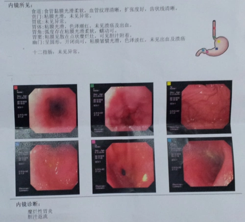 求消化科医生赐教胃病的治疗,大谢(附胃镜图).