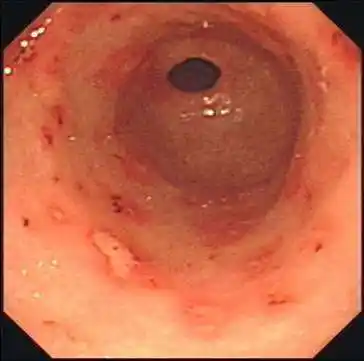 慢性非萎缩性胃炎伴出血,糜烂的图片 - 好大夫在线