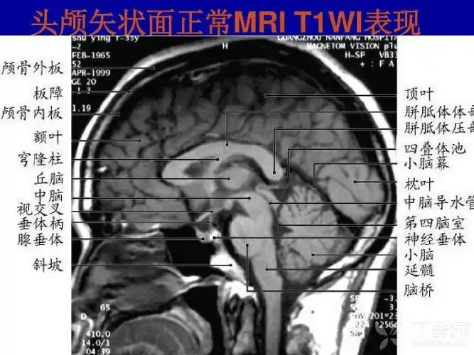 头颅mri正中矢状面----你能猜对几个?