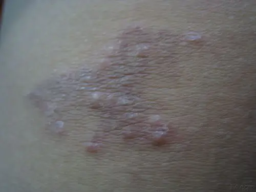 是苔癣化湿疹还是别的? - 皮肤及性传播疾病讨论版 - 爱爱医医学论坛