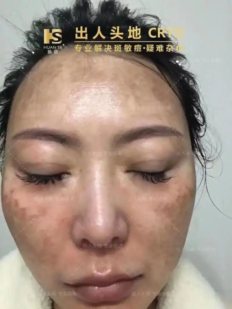 你确定不把脸上的斑祛掉吗