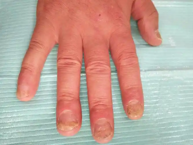 典型病例——银屑病甲 - 皮肤及性传播疾病讨论版 - 爱爱医医学论坛