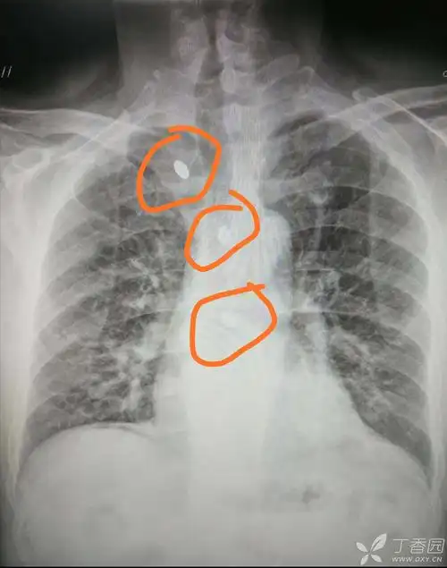 看片诊病之典型急诊胸片分享