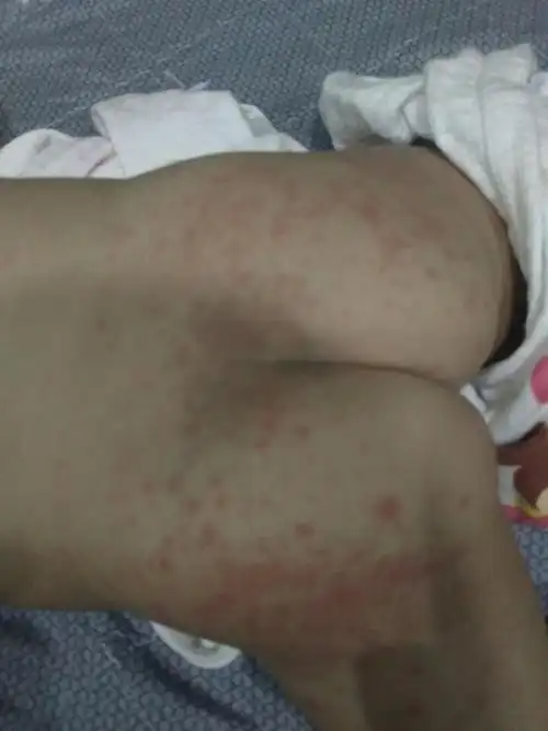 可能是尿不湿引起的