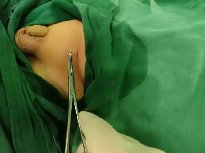 小儿疝气微创手术鉴赏