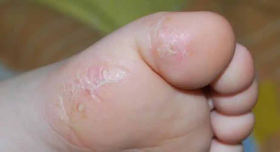 问:宝宝脚上长了类似脚气,癣一样的东西,怎么办啊?