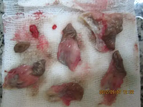 第三十九例三期结缔环状混合痔章女士术前术中术后图片集