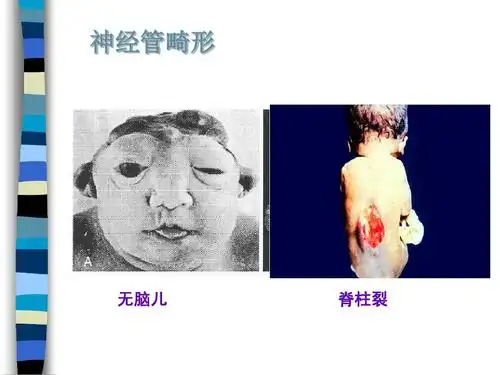 一个无脑畸形婴儿的前面观;这些无脑畸形婴儿通常在出生后的几天内