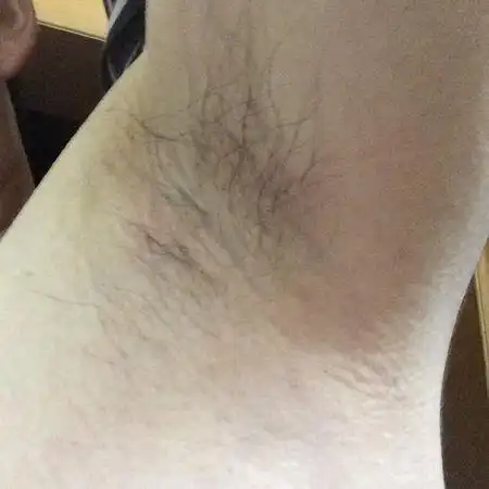 腋下长包了,今天才发现,这是怎么了啊?男,25岁.