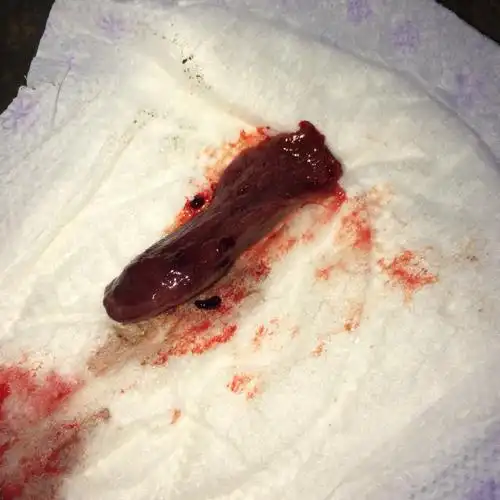 没有过夫妻生活,每次来大姨妈都很痛,还会有血块.