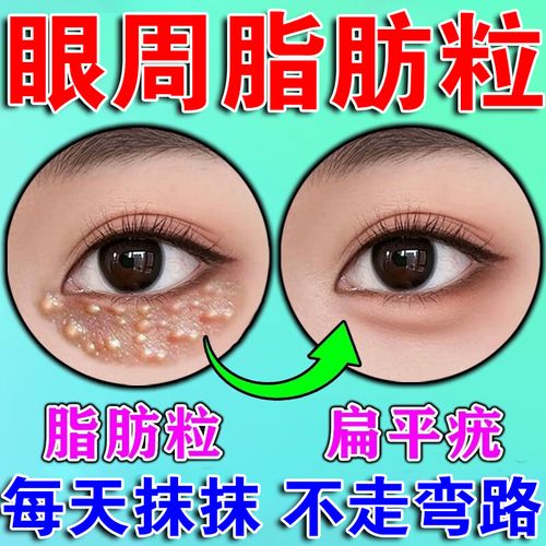 汗管瘤去除神器脂肪粒去除神器膏眼部专用油脂粒扁平疣白色颗粒男女