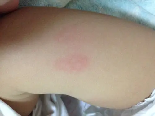宝宝这两天身上不知道出什么东西,一片红里面有一颗或几颗小白块,好像