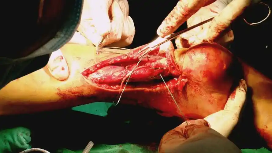 游离阔筋膜移植修复陈旧性跟腱断裂手术