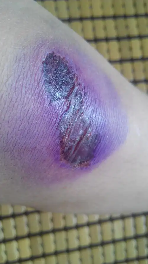 膝盖擦伤后上了药之后就就这两天没跑操,今天被老师强制跑,然而有点疼