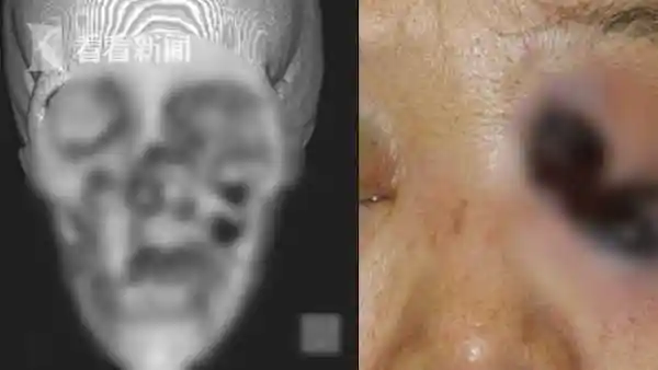 患者肺部长黑霉印度出现毛霉菌病合并新冠感染病例已致8人死亡