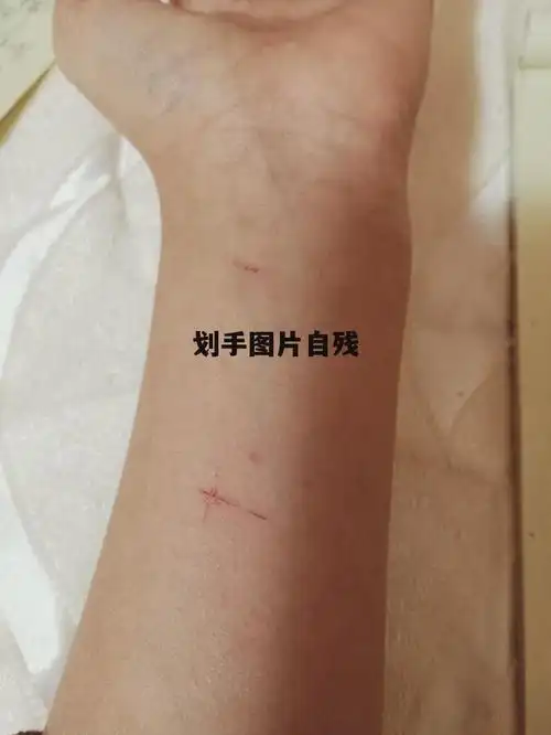 划手图片自残包扎 划手图片自残