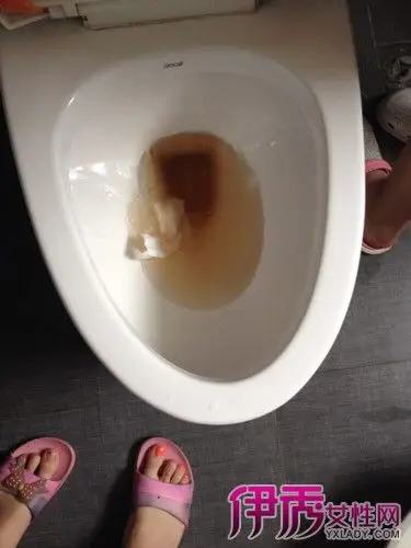 通过观察小便的情况是可以发现很多问题的,因为小便能够排除人们身体