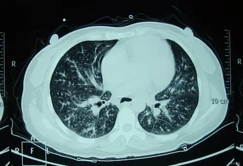 【影像读片】影像读片 肺泡细胞癌?结节病?抑或其它 [病例帖]
