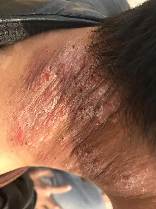 这是什么情况,用什么办法治疗,救专家看看.