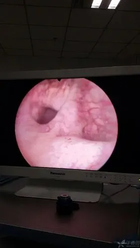 膀胱内憩室,这个算小的,其他3个都比这个大.