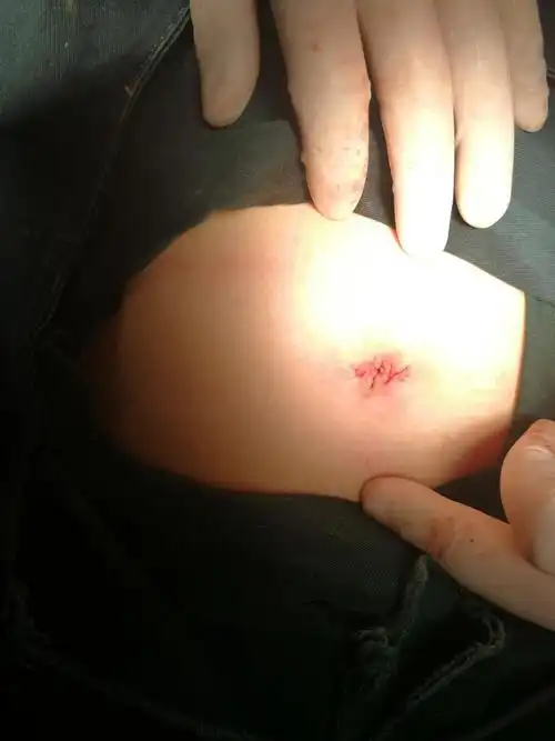 石术(术者:刘天祥,准旗中心医院外一 取出结石观察胆囊管胆汁排出通畅