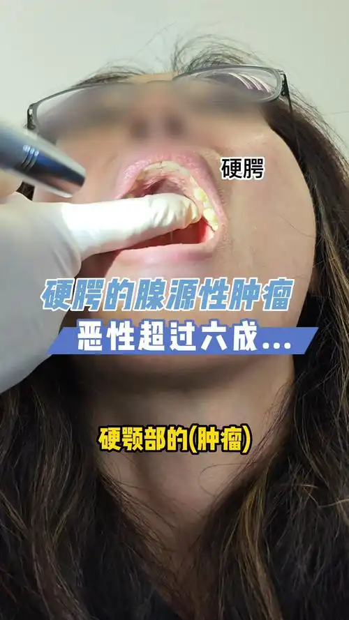 硬腭的腺源性肿瘤,恶性的要超过六成.