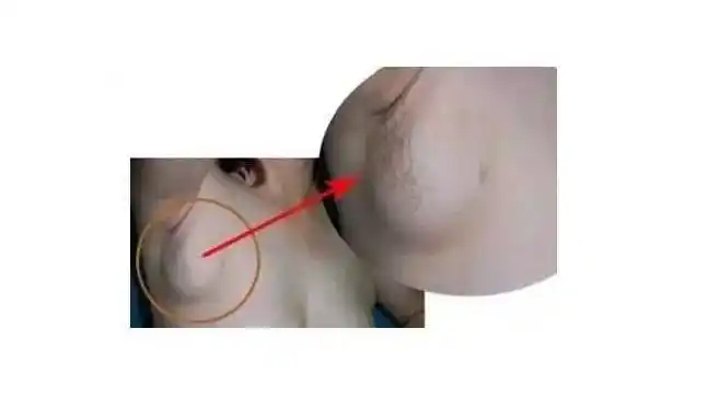 穿吊带露副乳很尴尬如果消除副乳