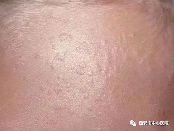 皮肤上长的瘊子怎么弄掉(皮肤上的小瘊子)(5)