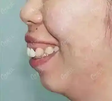 细说骨性龅牙分几级?轻重度等程度划分图片全解析