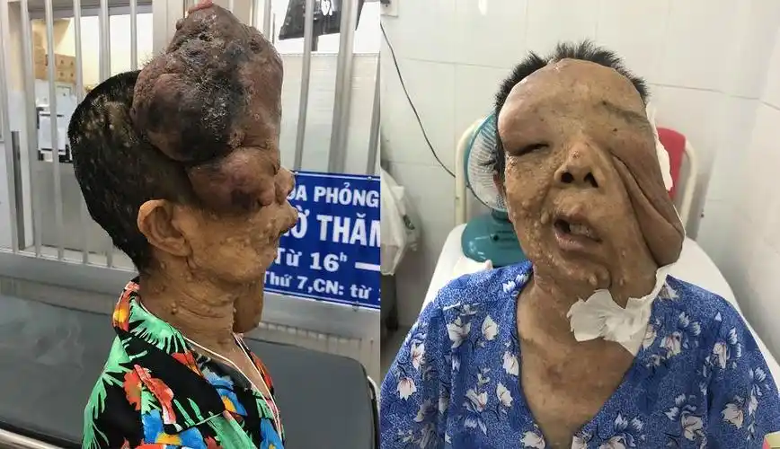 为女病人切除脸部两大神经纤维瘤