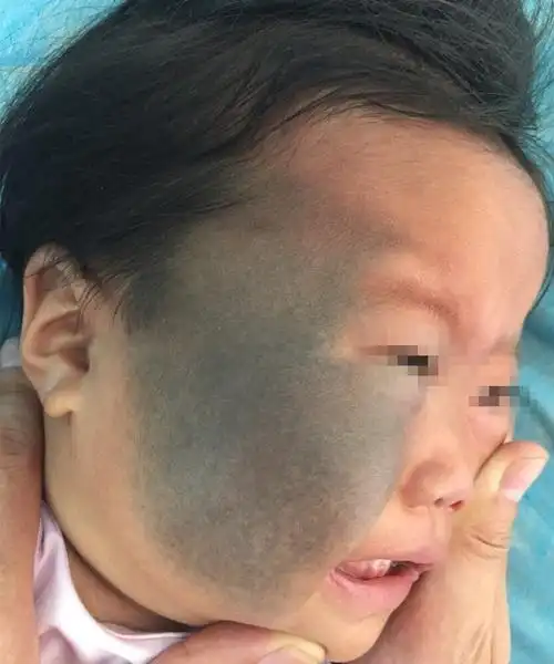 邓主任胎记大课堂之如何让脸上的乌云散去