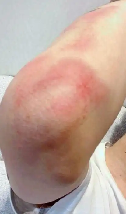 范丞丞拍戏受伤!手臂上全是淤青,粉丝心疼不已