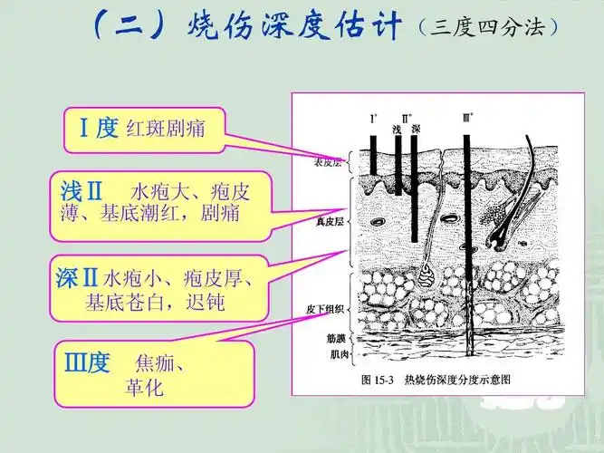 烧伤课件_word文档在线阅读与下载_无忧文档