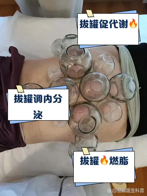 拔罐减肥减肚子拔什么地方最合适