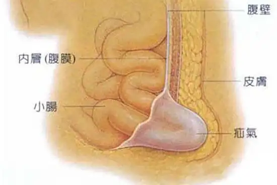 女人疝气是什么原因女人疝气怎么治疗