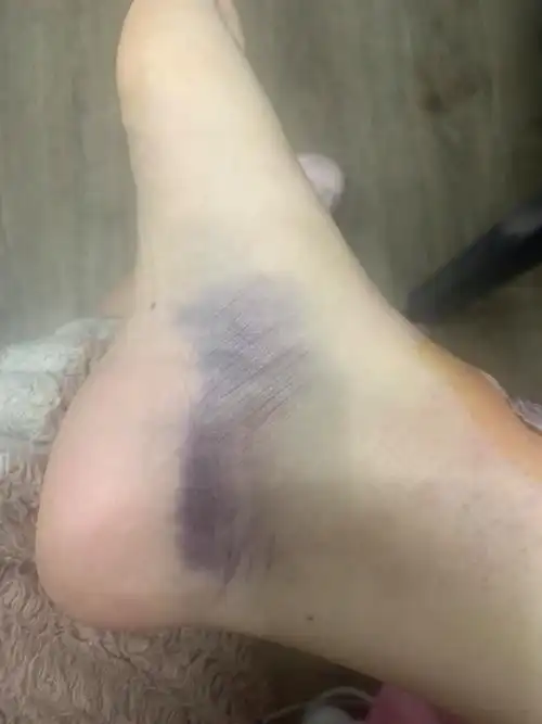 电瓶车摔伤全是淤青