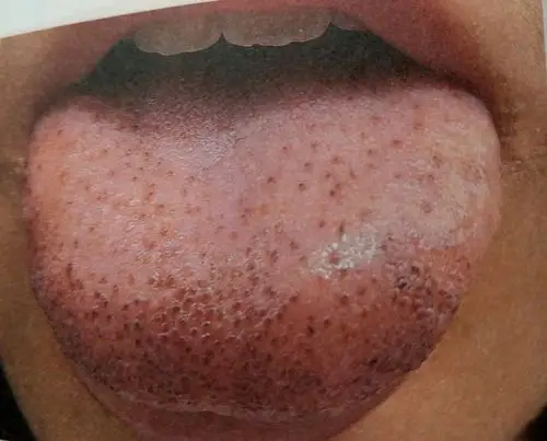 血瘀体质的人:记忆力差,身体很多部位出现瘀斑,经常感觉喉咙干,皮肤