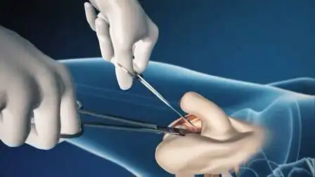 女变男变性手术视频