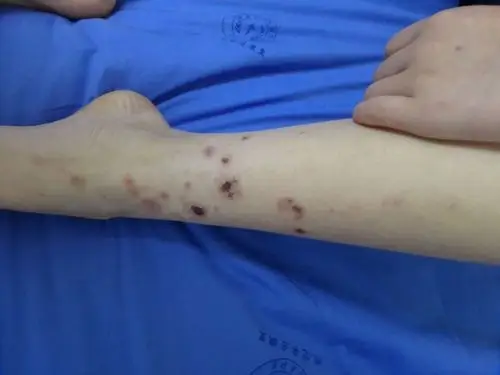 现在考虑变应性皮肤血管炎,目前四肢肌痛症状逐渐加重,血象也高,wbc
