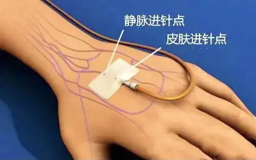 拔针后按压您按对了的吗