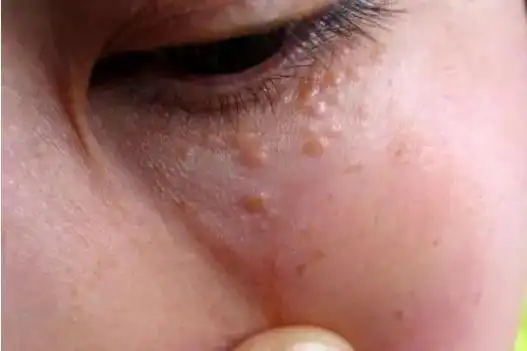 眼部最近老长脂肪粒