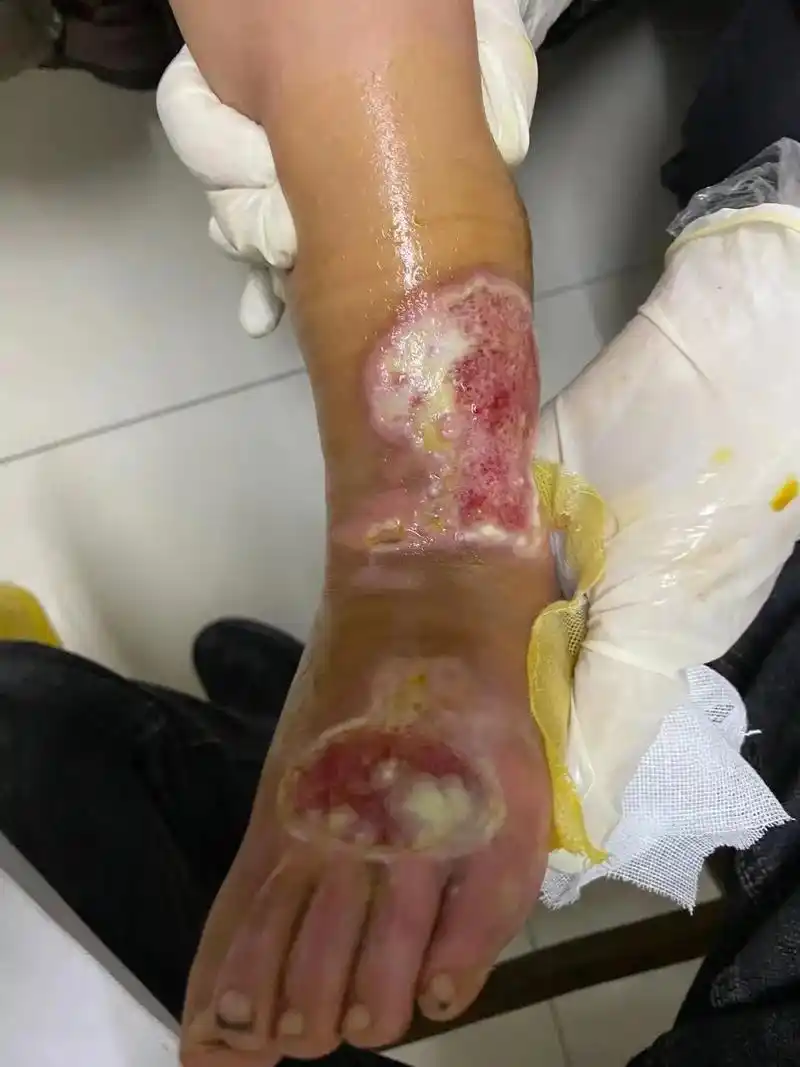 深二度烫伤恢复前后对比照片图 - 抖音