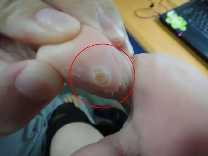 大母脚趾上长了一个"茧子",请问需要怎样处理?