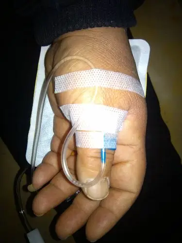 手屈一指的输液