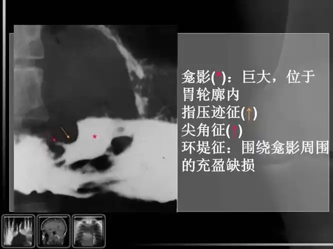 汇总消化道疾病影像诊断与鉴别