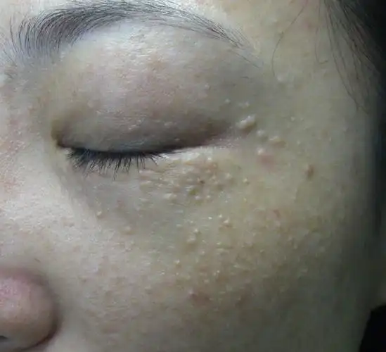 !--haodf:8:hanguanliu--> !--haodf:8:hanguanliu-->汗管瘤 !