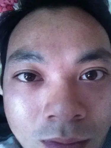 眼球突出的问题本人在三甲医院武汉同济医院看过包括眼部ct,甲亢三项